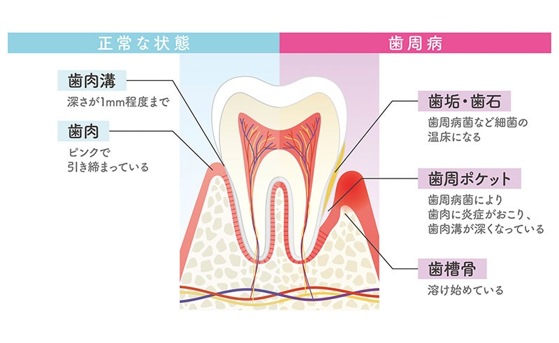 正常な状態(左)と歯周病(右)の比較図。正常:歯肉溝は深さ約1mmまで、歯肉はピンクで引き締まっている。歯周病:歯垢・歯石が歯周病菌など細菌の温床となり、歯周ポケットができて歯肉に炎症が起こり歯肉溝が深くなっている。歯槽骨は溶け始めている。