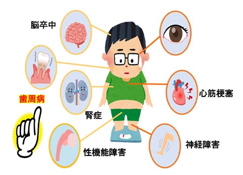 歯周病が全身の健康に影響し、脳卒中や心筋梗塞、腎症、神経障害、性機能障害などの原因となる場合があることを示す図。